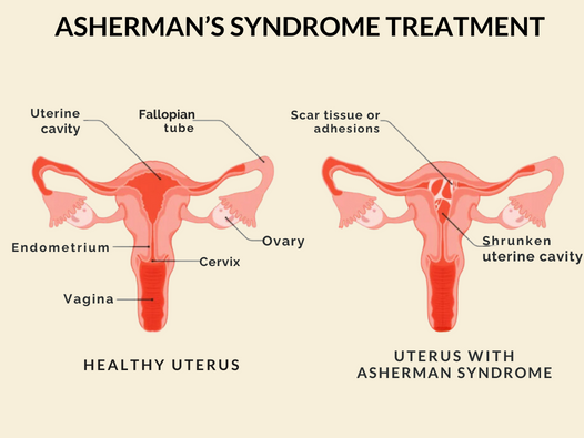 ASHERMAN’S SYNDROME TREATMENT