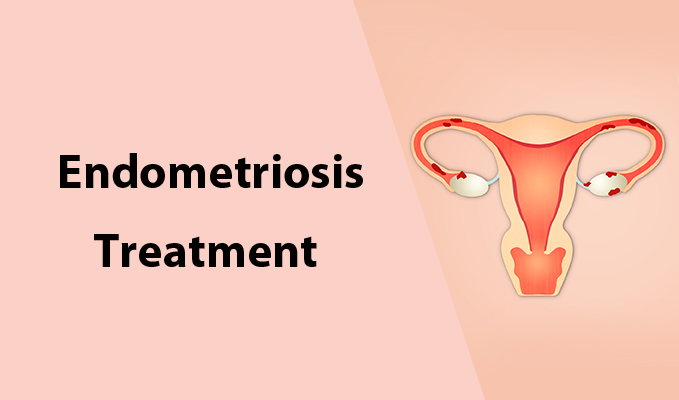 5 Minimally Invasive Endometriosis Treatments That Could Change Your Life
