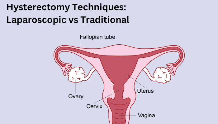 Comparing Hysterectomy Techniques: Laparoscopic vs Traditional Approaches