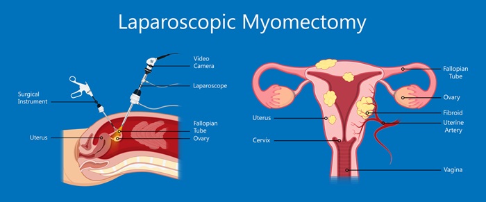 Benefits of Choosing Laparoscopic Myomectomy for Fibroid Removal