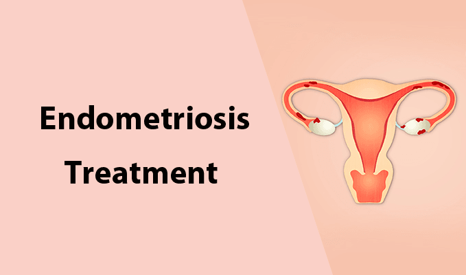 5 minimally invasive endometriosis treatments that could change your life