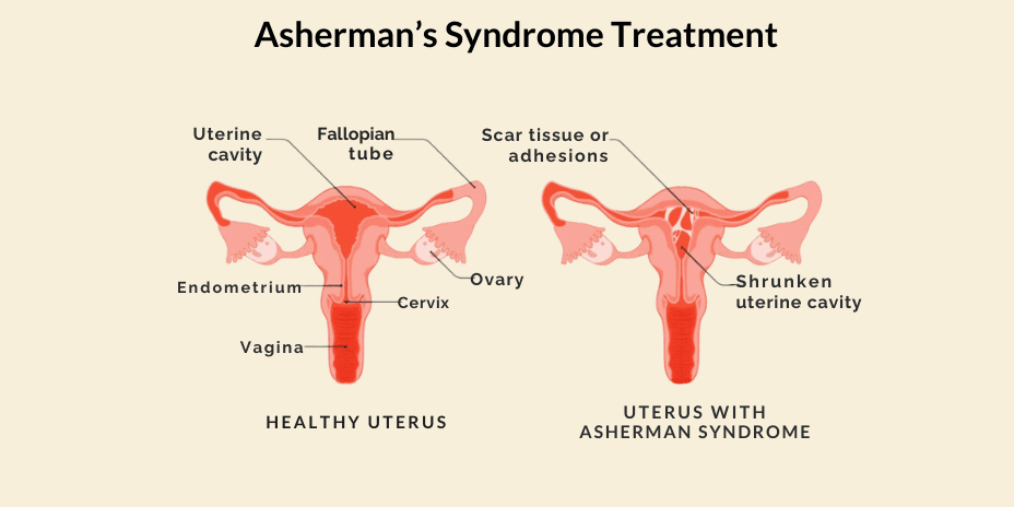 asherman’s syndrome treatment