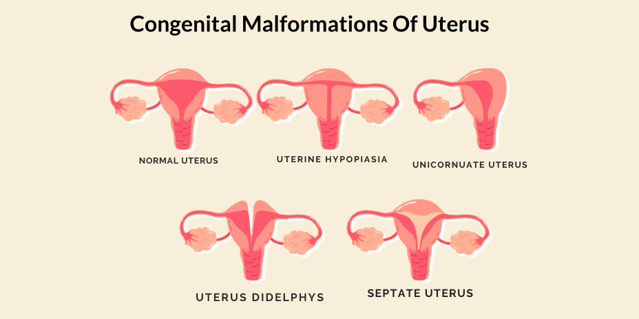 congenital malformations of uterus