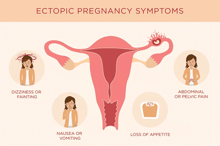 ectopic pregnancy causes, symptoms and treatments