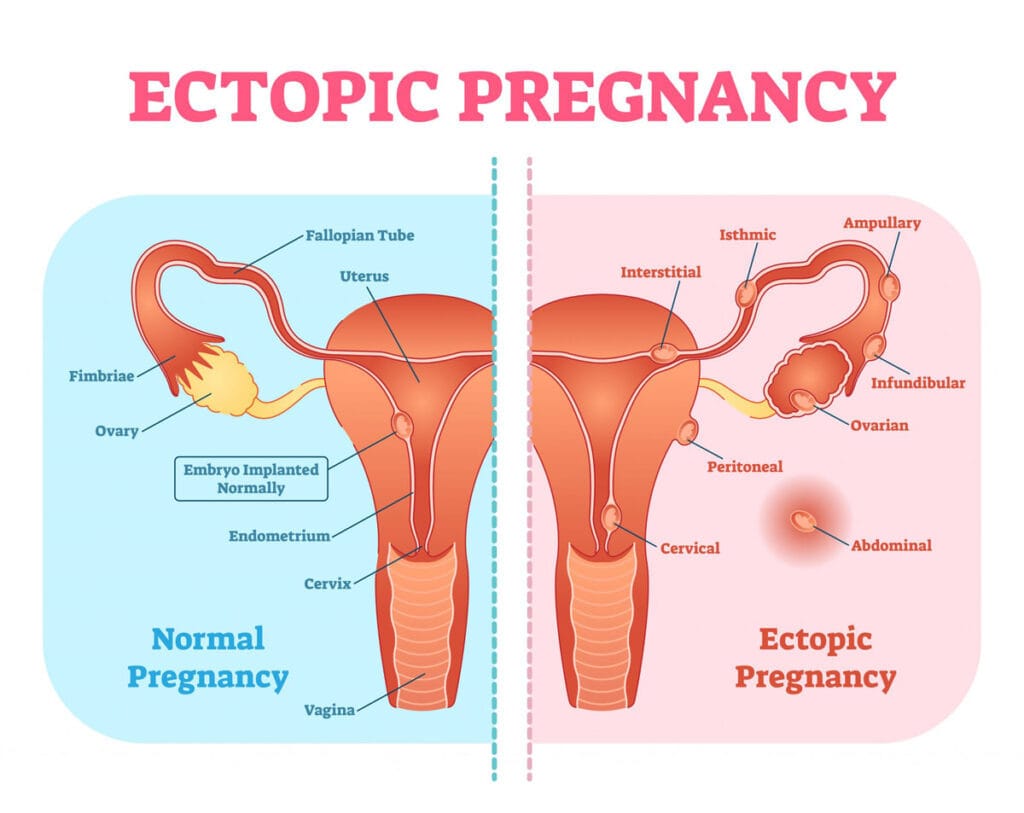 ectopic pregnancy