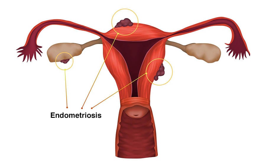 Endometriosis treatment