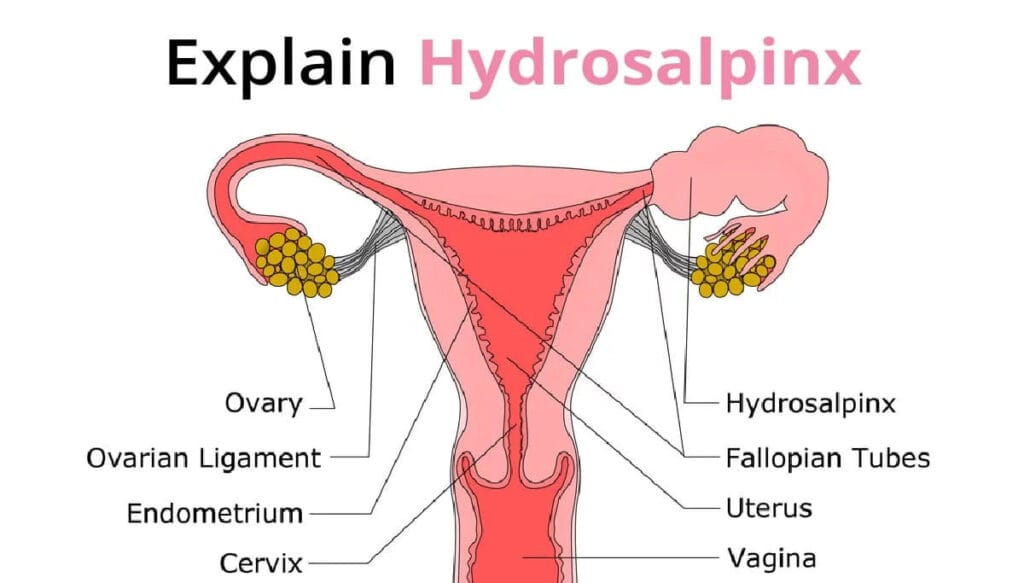 explain hydrosalpinx