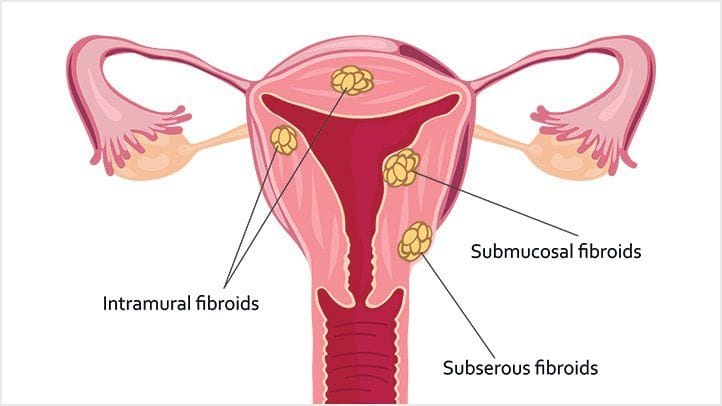 fibroids