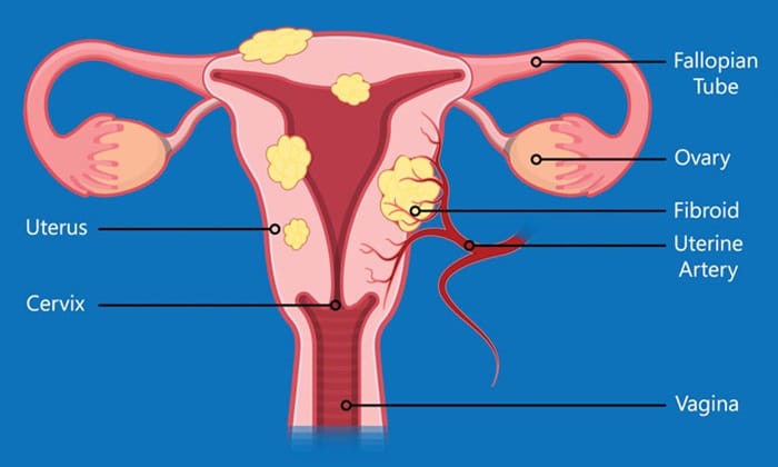 laparoscopic myomectomy