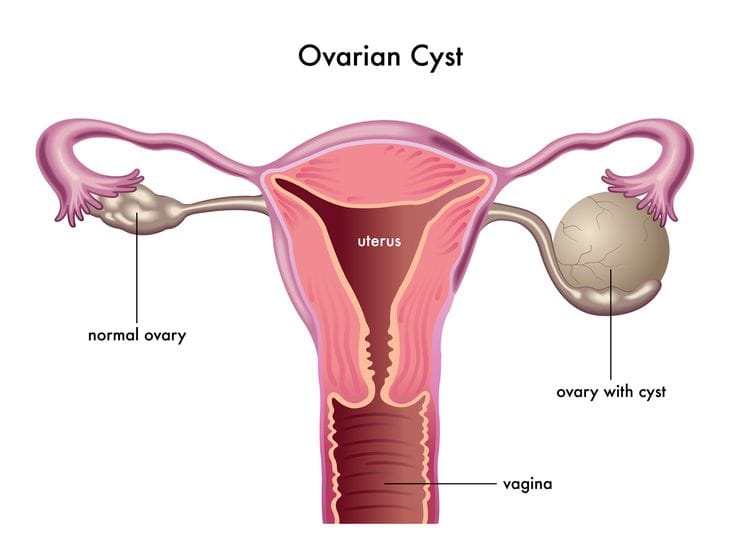ovarain cysts