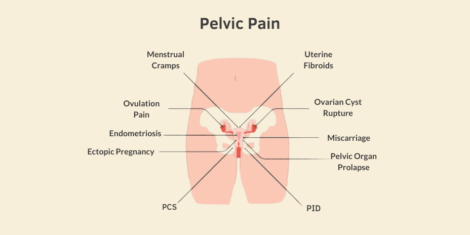 pelvic pain infographic