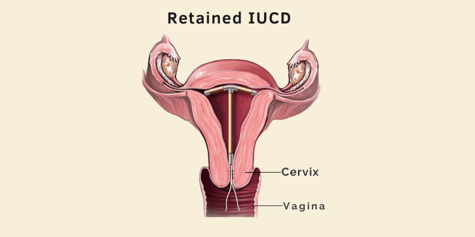 retained iucd