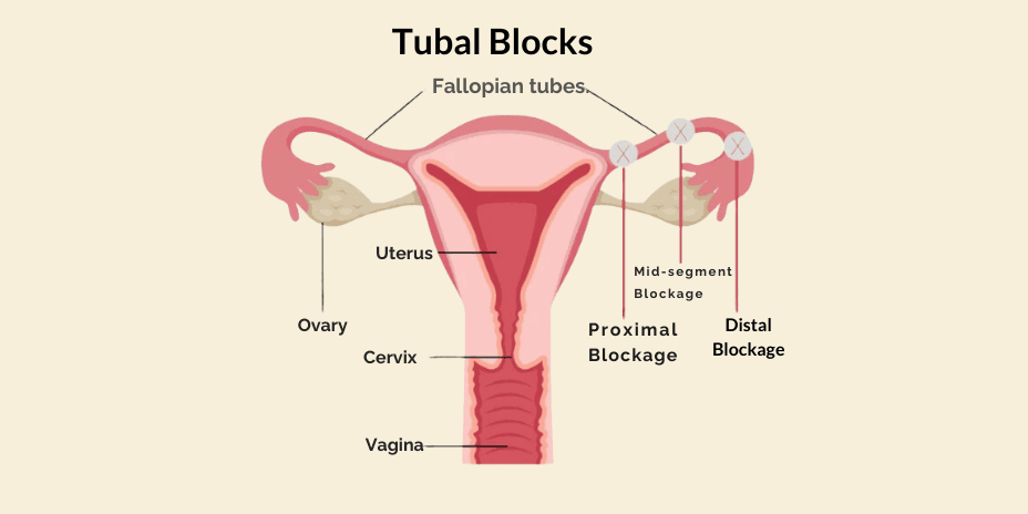 tubal blocks