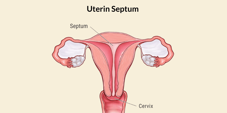 uterin septum