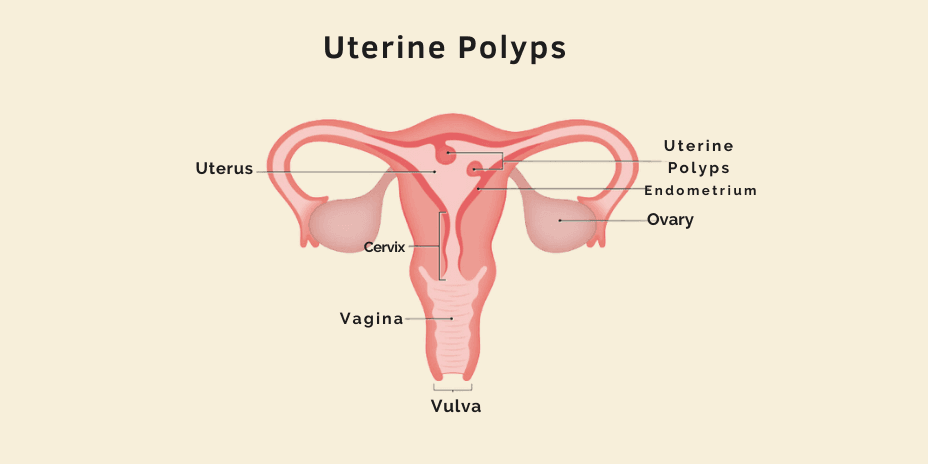 uterine polyps